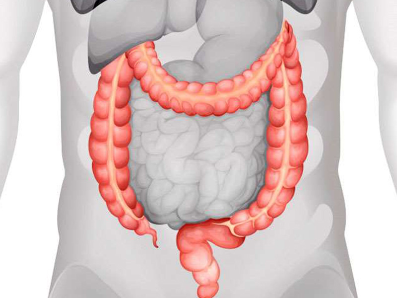 कोलन कैंसर के लक्षण