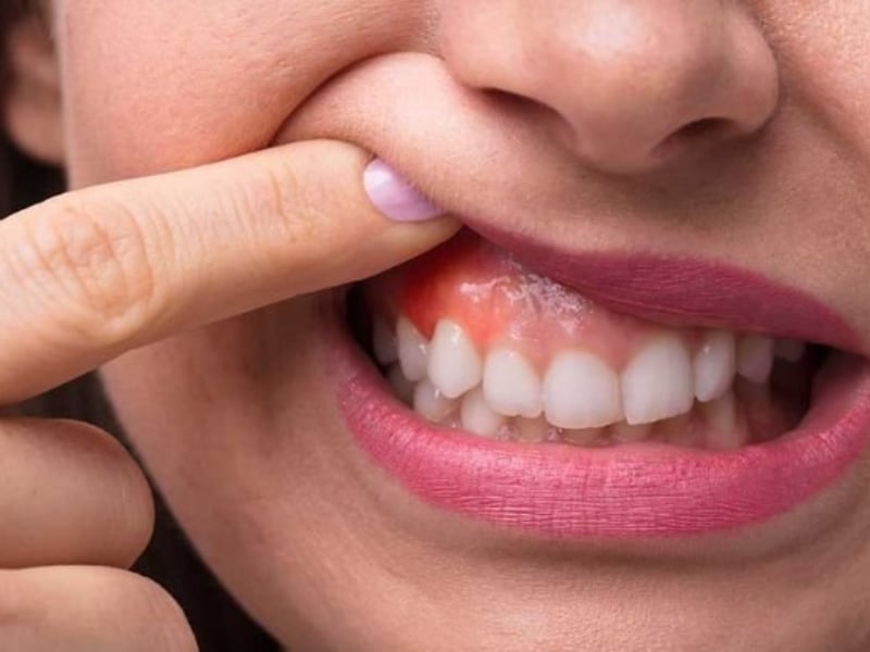 मसूड़ों का कैंसर के लक्षण | गम कैंसर के लक्षण