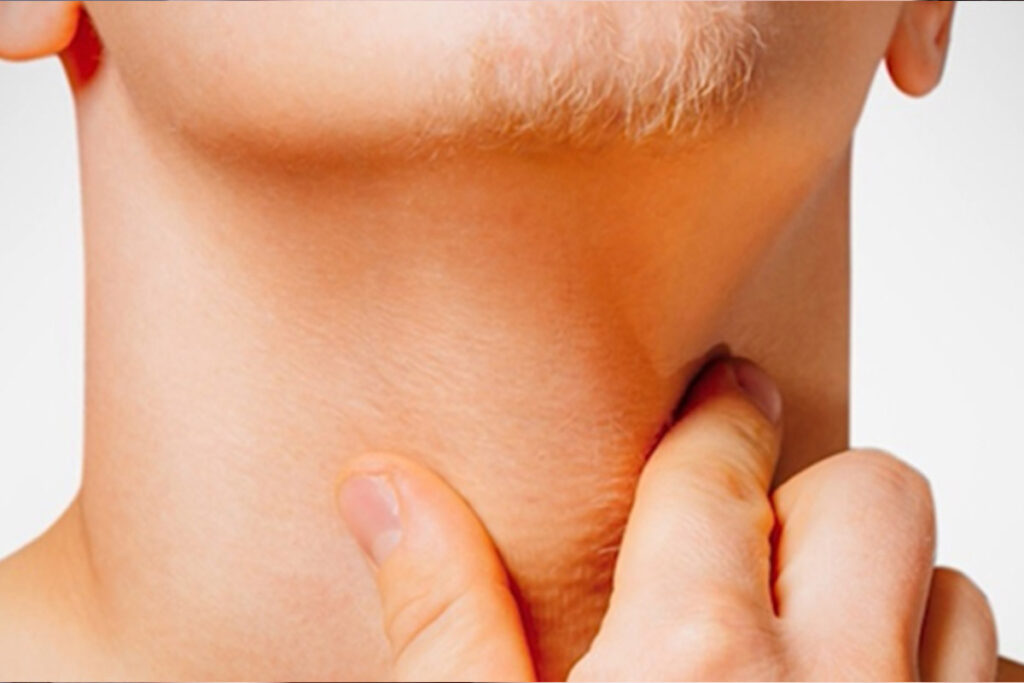 लिम्फ नोड कैंसर के लक्षण