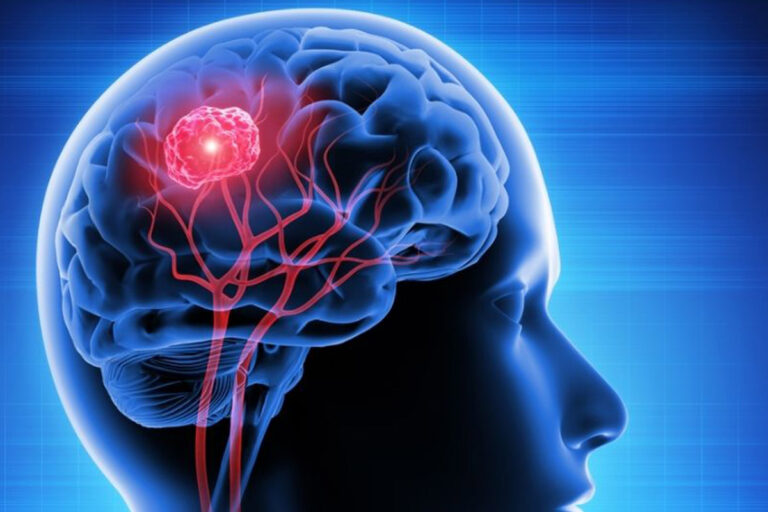 ब्रेन कैंसर के लक्षण