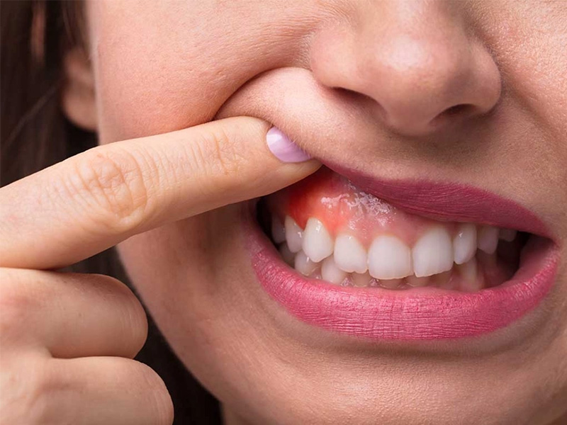 मुंह के कैंसर के लक्षण, कारण, उपचार विकल्प Mouth Cancer In Hindi