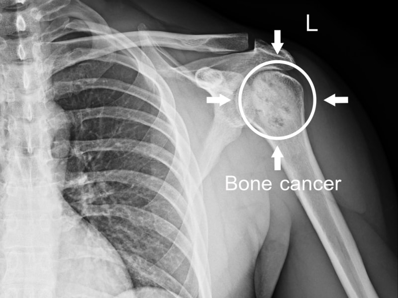 बोन कैंसर के शुरुआती लक्षण
