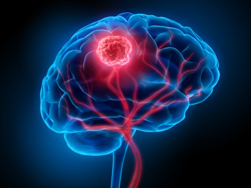 ब्रेन ट्यूमर के लक्षण