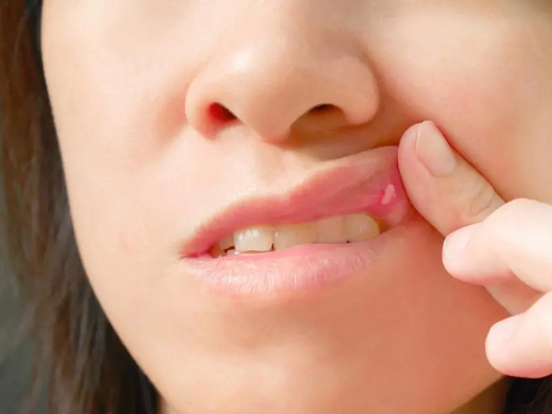 होठ के कैंसर के लक्षण