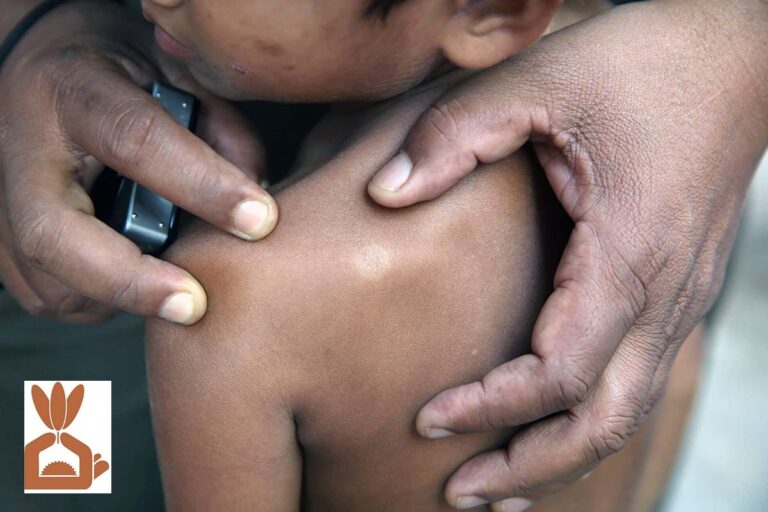 National Leprosy Eradication Programme