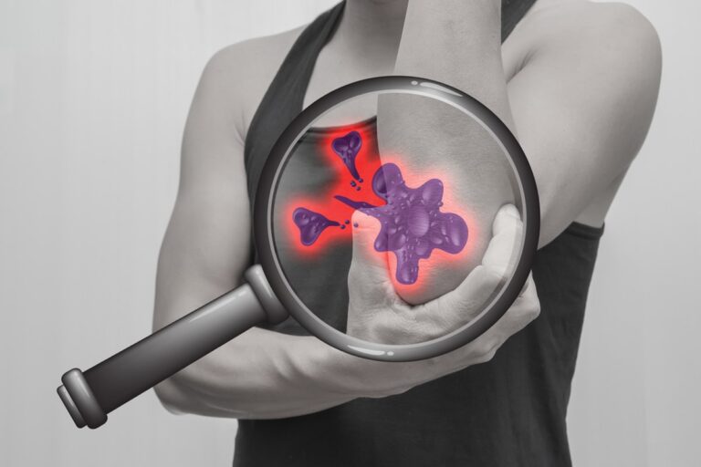 बोन कैंसर के लक्षण