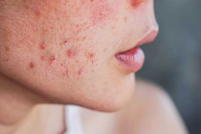 ल्यूकेमिया के लक्षण