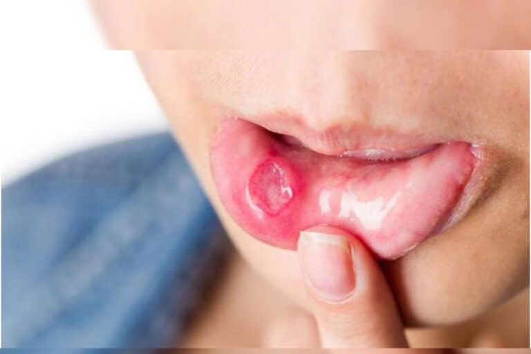 होठ के कैंसर के लक्षण
