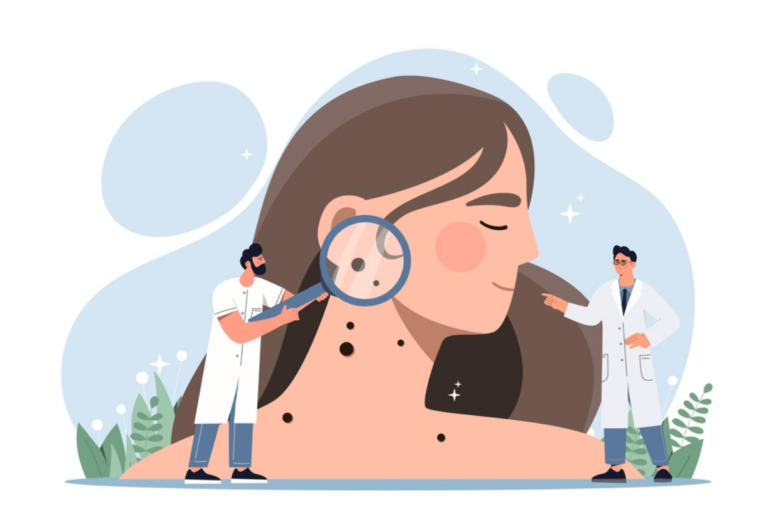 मेलेनोमा के लक्षण