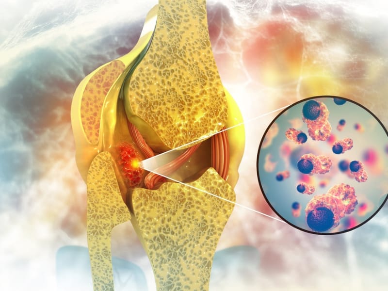 How Long Can You Live When Cancer Spreads To Bones