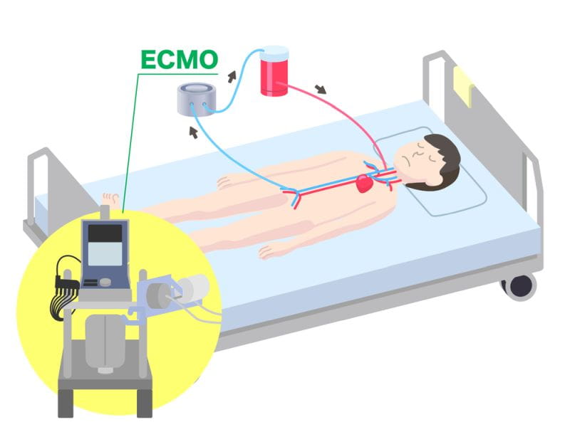 ECMO Treatment Cost In India