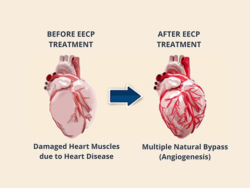 EECP Therapy Cost In India