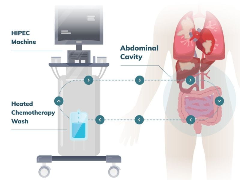 Cost Of HIPEC Surgery In India