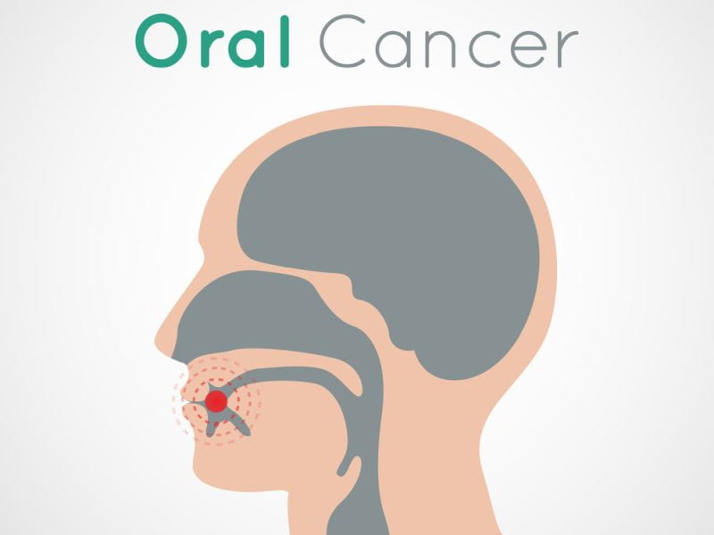 Cost Of Oral Cancer Treatment In India