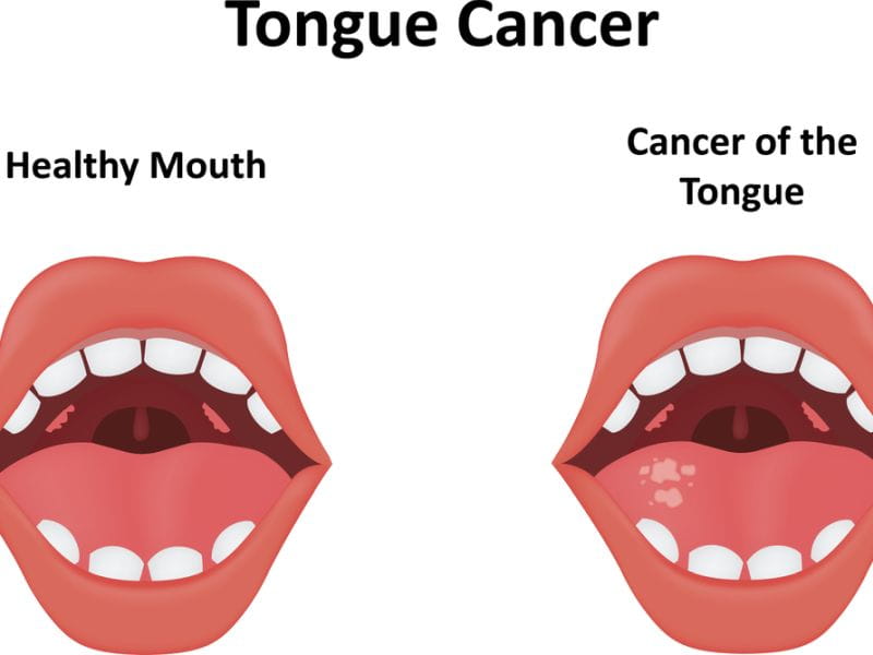 Average Cost Of Oral Cancer Treatment In India