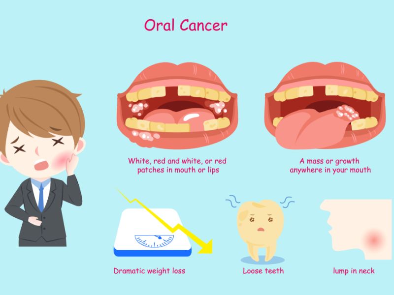 Cost Of Mouth Cancer Treatment In India