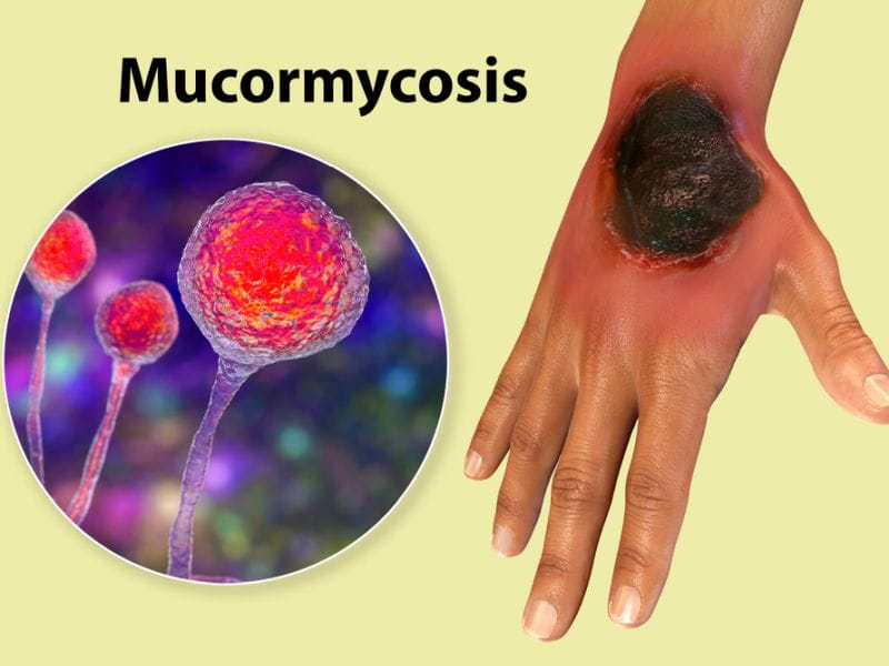 Black Fungus Best Treatment In India
