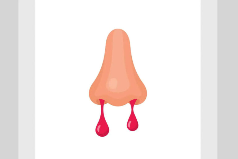 नाक से खून आना