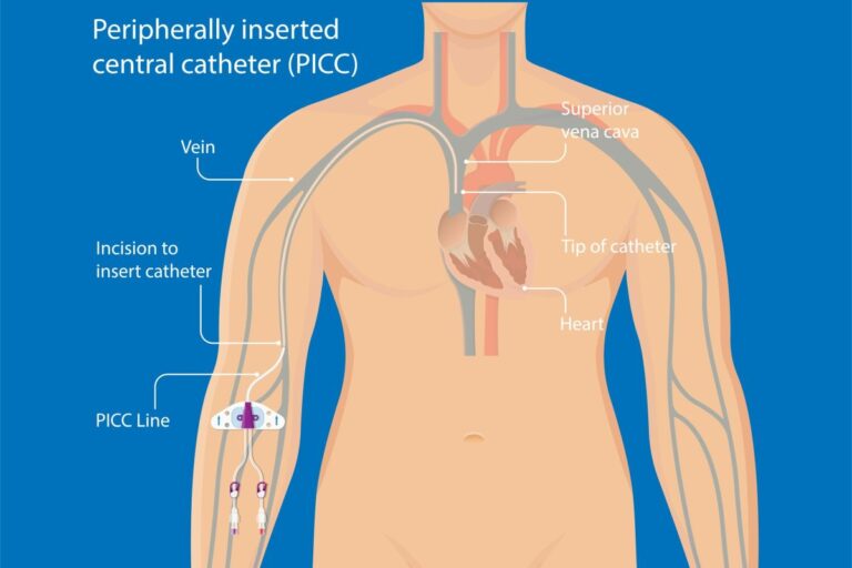PICC Line Insertion