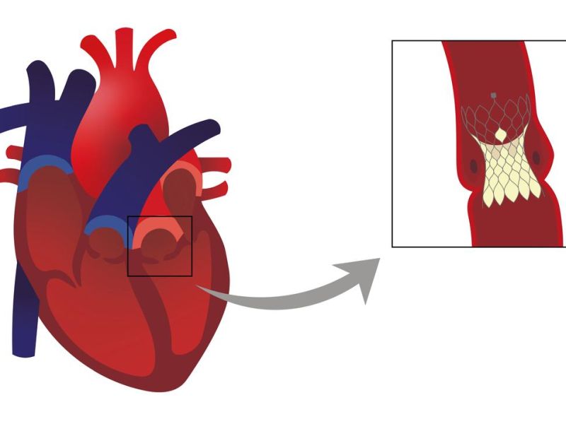 Cost Of TAVI Procedure In India