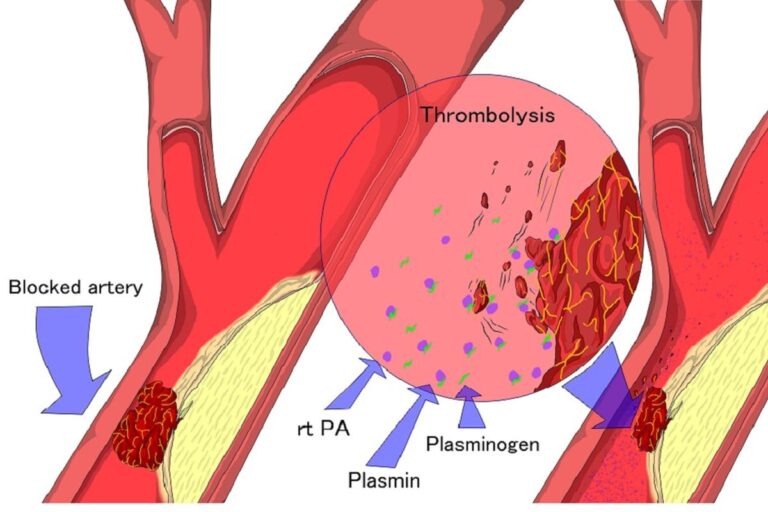 Thrombolysis