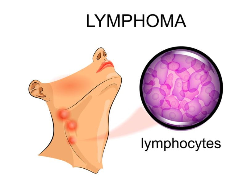 Lymphoma Treatment Cost In India
