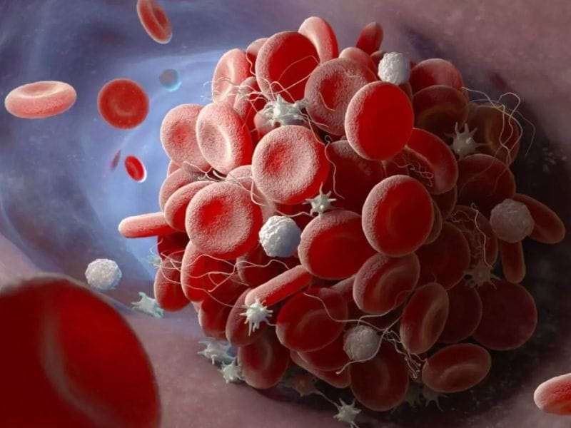 thrombolytic therapy