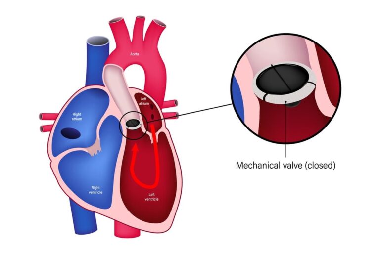 Aortic Valve Replacement Cost In India