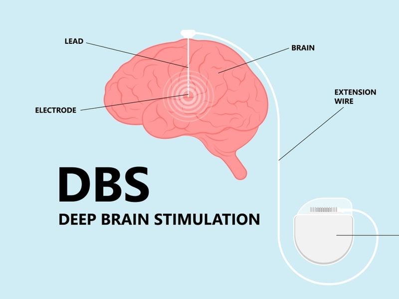 Deep Brain Stimulation Surgery Cost In India