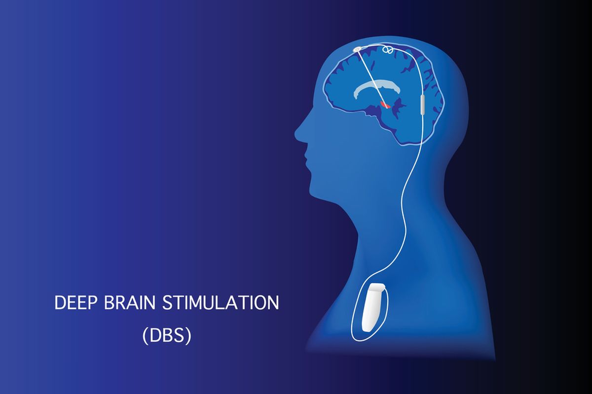 First Deep Brain Stimulation Deep Brain Stimulation Cost In India