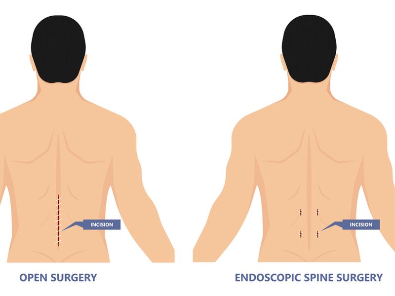 Endoscopic Spine Surgery Cost India