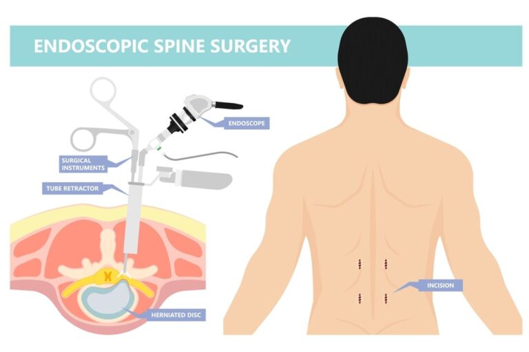 Endoscopic Spine Surgery Cost In India