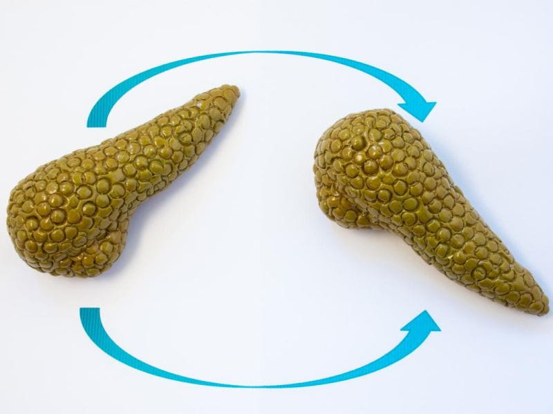 Pancreas Transplant In India