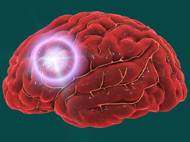 Blood Clot Treatment