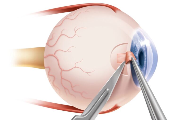 Glaucoma Surgery Cost In India