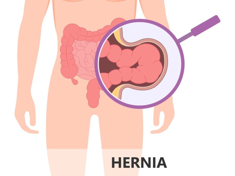 Hernia Treatment Without Surgery In India
