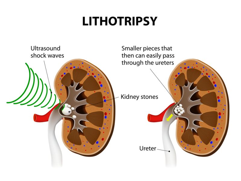 Lithotripsy Meaning