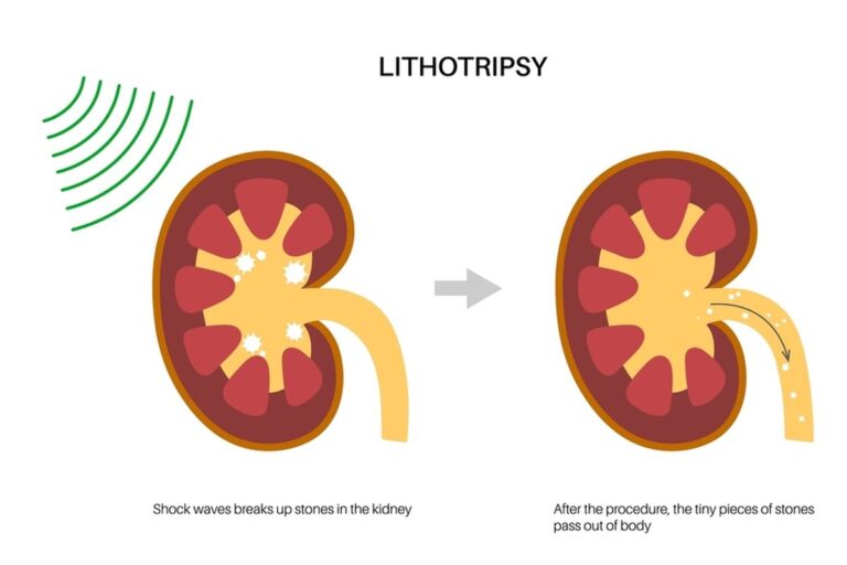 Lithotripsy