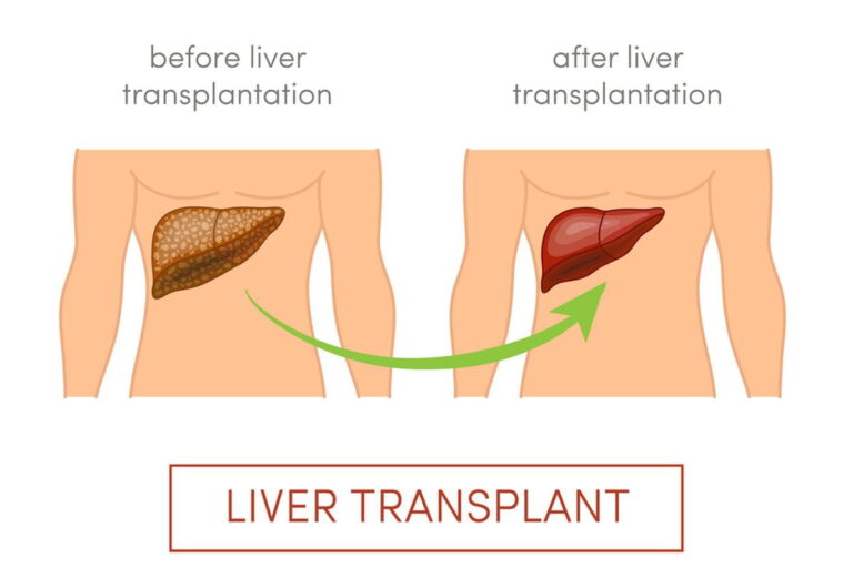 Liver Transplant Cost In Jaipur