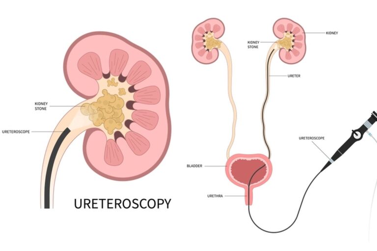 Ureteroscopy Procedure