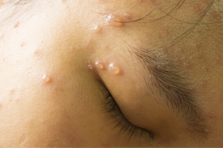 Chicken Pox Treatment