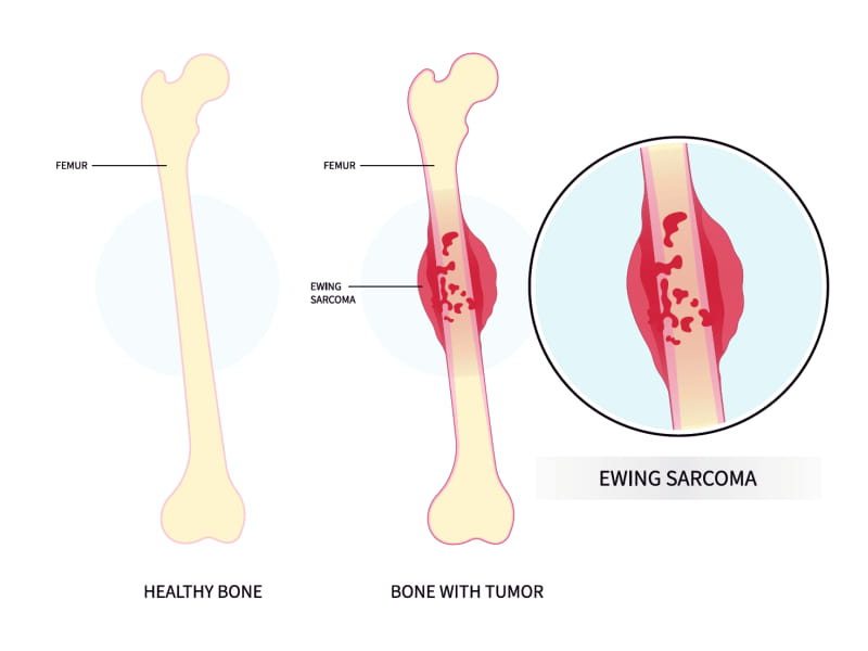 Bone Cancer