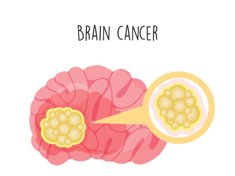 Brain Cancer
