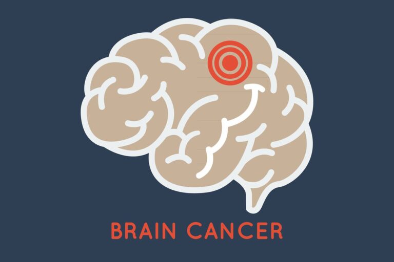 Brain Cancer Symptoms