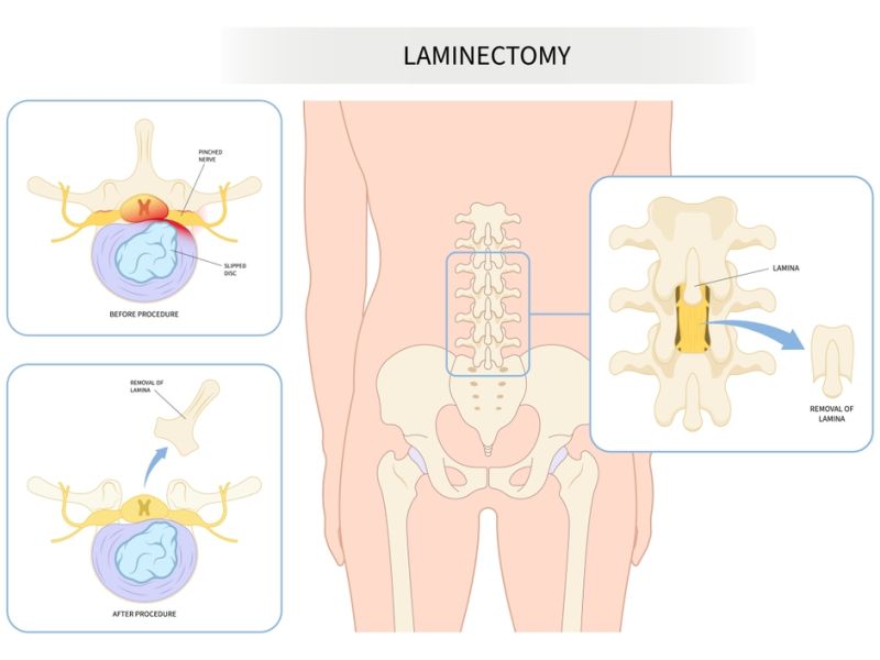 Laminectomy Meaning