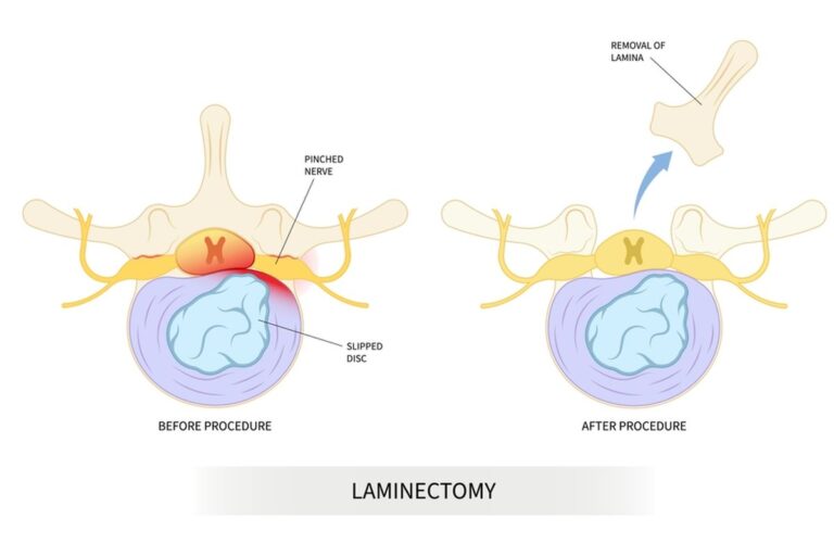 Laminectomy