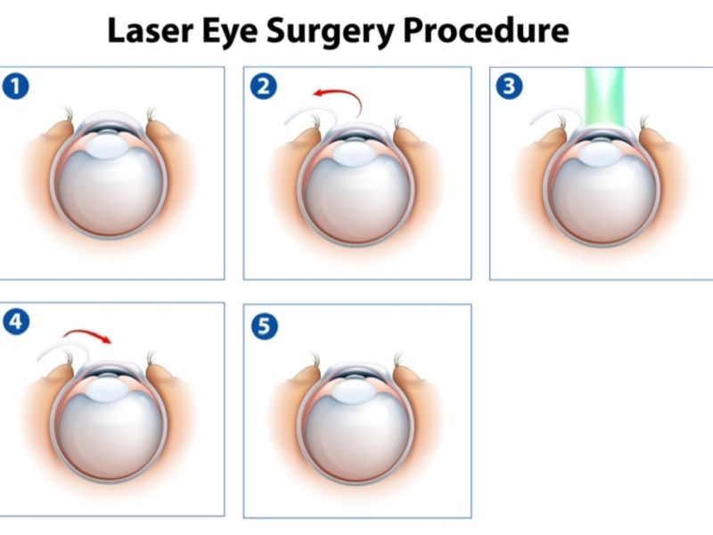 Eye Lasik Surgery Cost In India