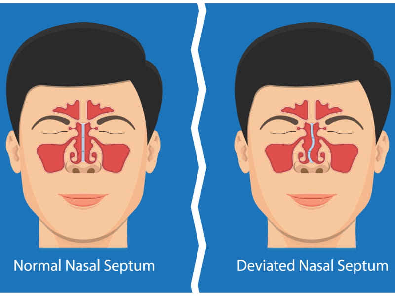 Septoplasty Surgery