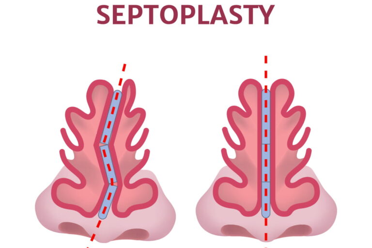 Septoplasty