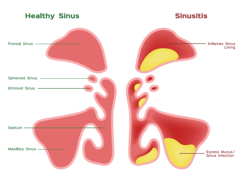 Before And After Sinus Surgery